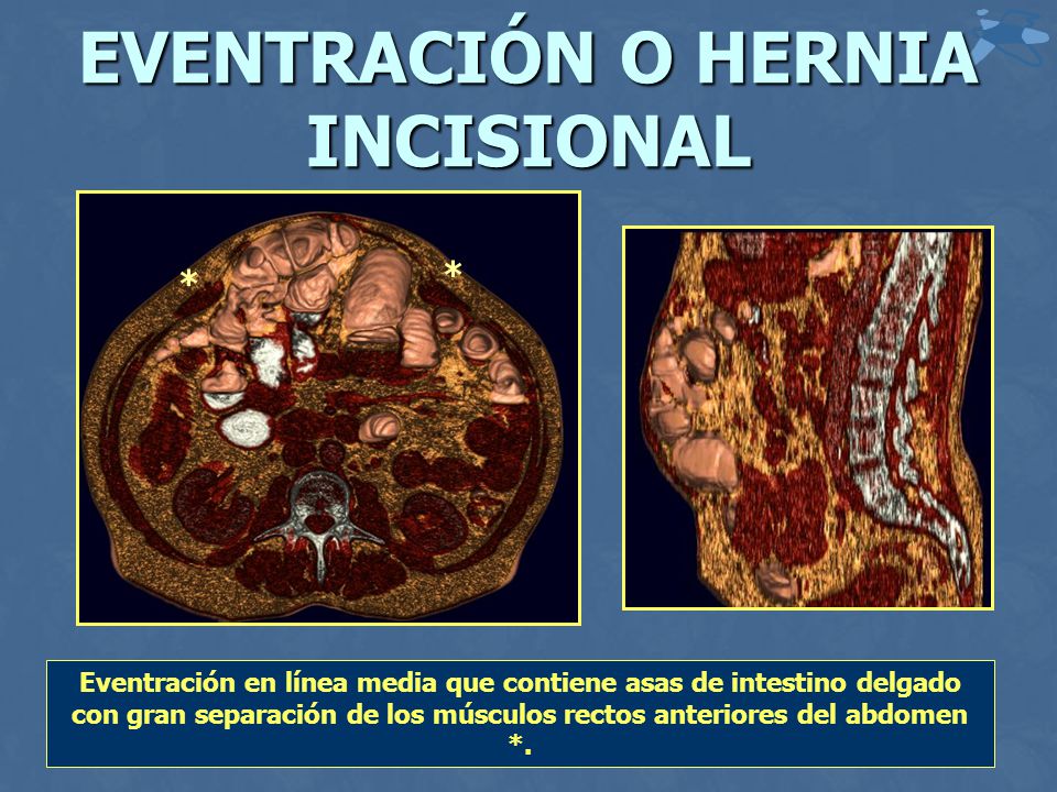eventracion postquirurgica